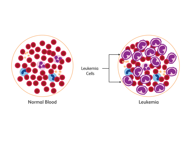 A diagram comparing normal blood composition against one with leukemia cells.