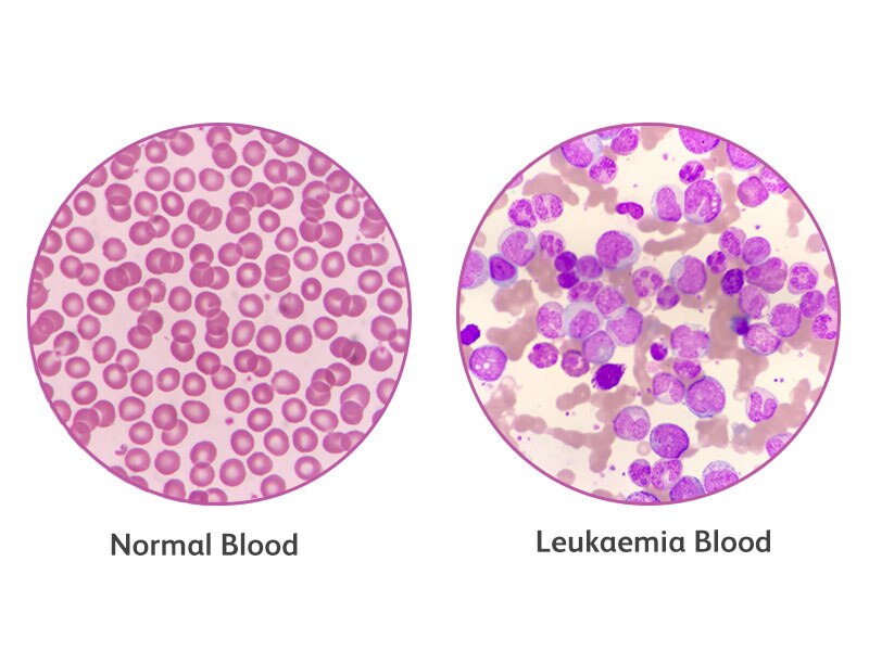 A diagram comparing normal blood composition against one with leukemia cells.