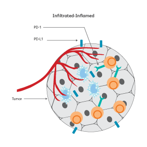 Diagram showing inflamed tumor cells.
