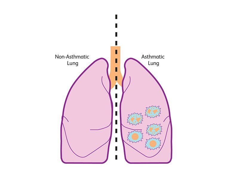 Illustration comparing non-asthmatic and asthmatic lungs.
