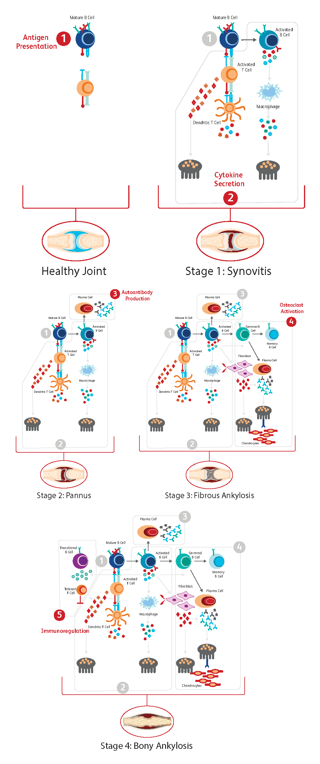 Diagram illustrating process and degrees of different forms of rheumatoid arthritis.